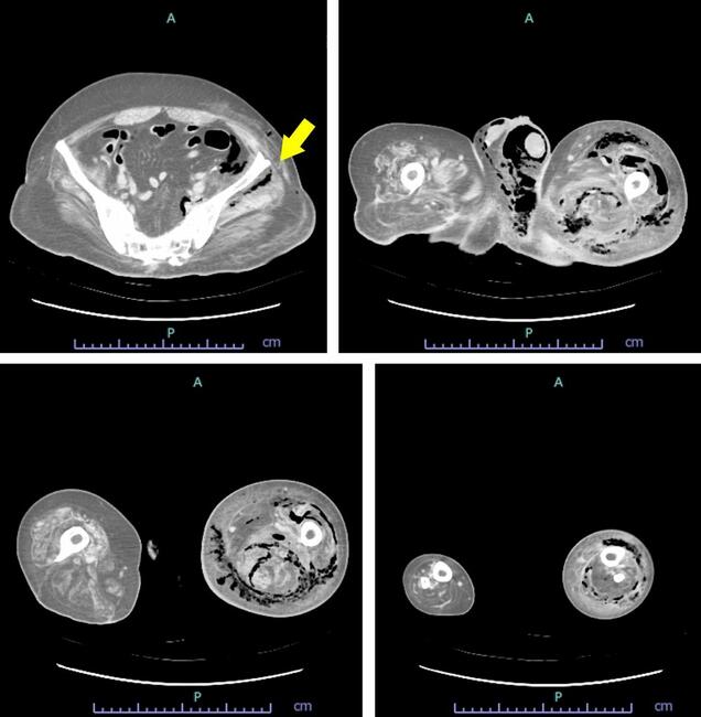 Limb Salvage in Extensive Necrotizing Soft Tissue Infection with
